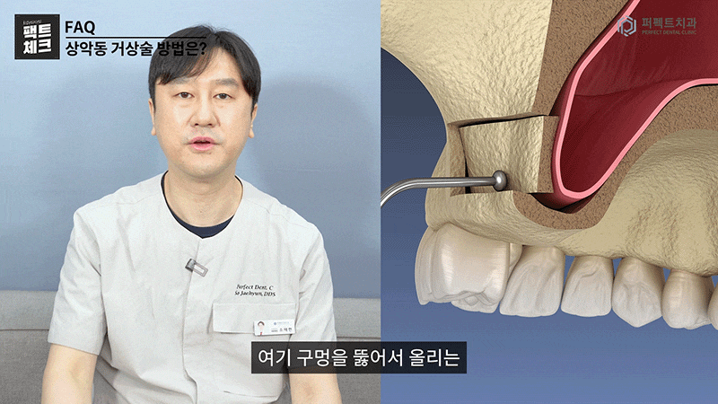 임플란트 뼈이식 질문 BEST 모음집_zip ② 관련 이미지 3