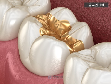 충치치료 인레이, 어떤 경우에? 관련 이미지 3