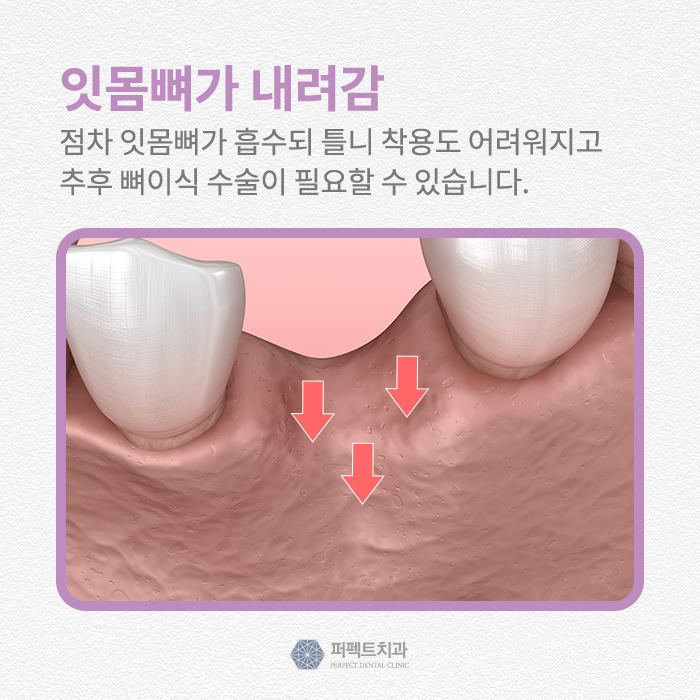 빠진 치아를 그대로 방치한다면? 관련 이미지 3