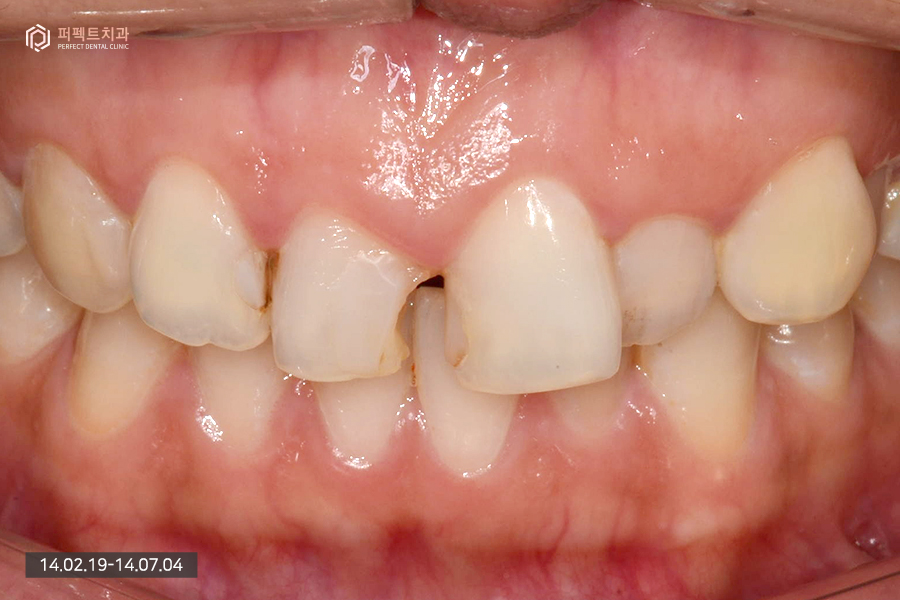 충치치료+교정 후 라미네이트, 세가지 복합적인 치료의 기간은?! 관련 이미지 2