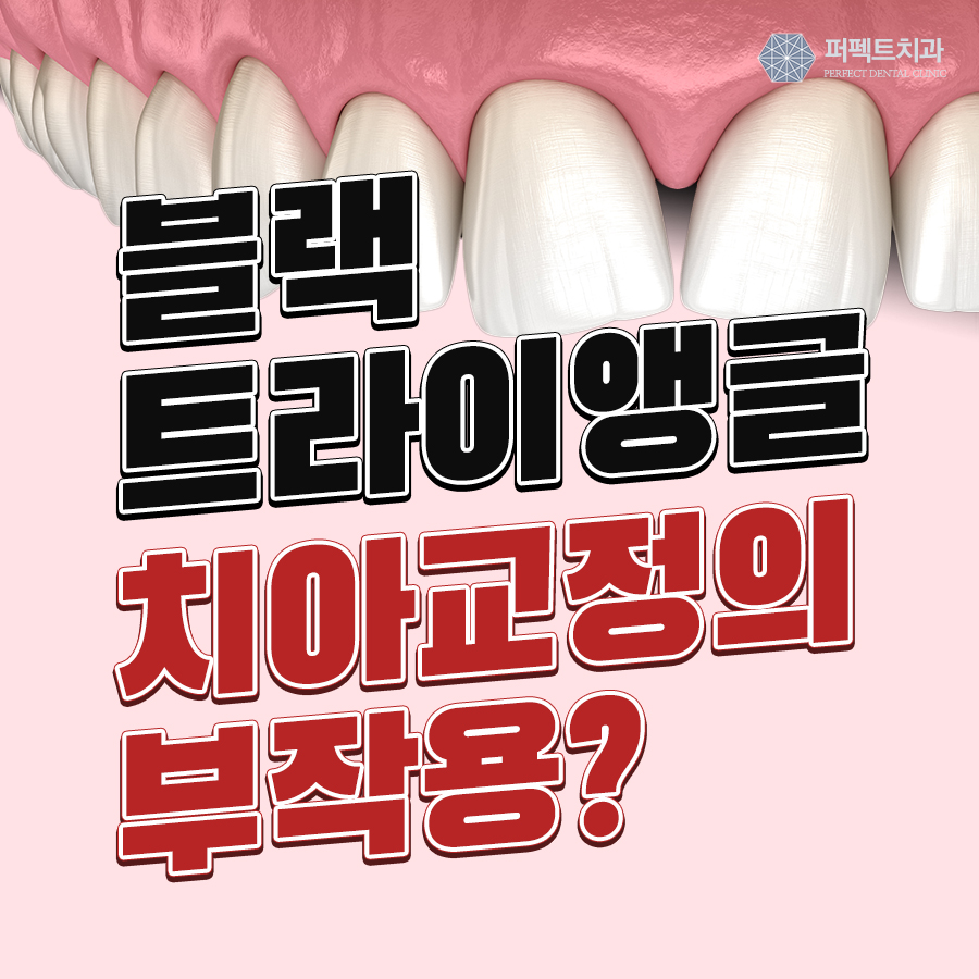 블랙트라이앵글, 치아교정의 부작용일까? 관련 이미지 1
