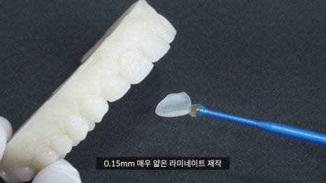 앞니 라미네이트 가격과 두께의 진실 관련 이미지 2