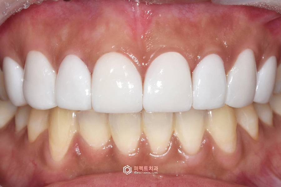 6년 전 라미네이트 교체&연장, 그 이유는?😯 관련 이미지 8