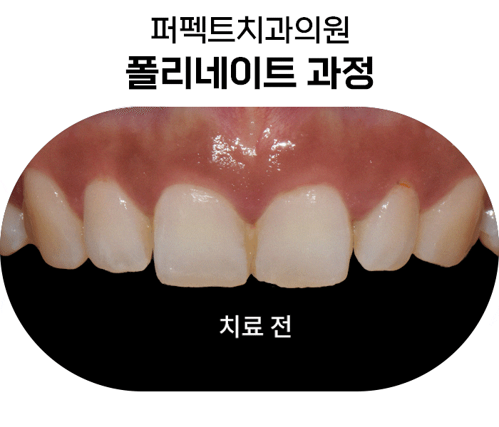 라미네이트 치료 시 참고사항은? 관련 이미지 5