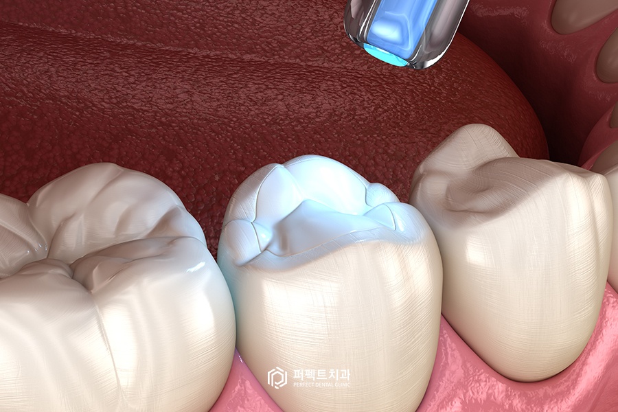 앞니 레진치료의 장단점은? 관련 이미지 4