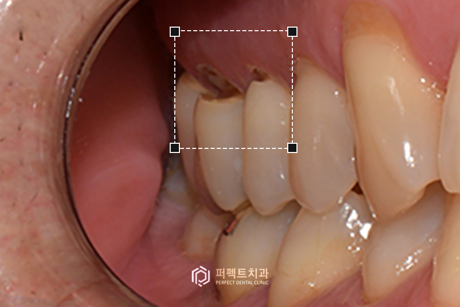 치경부마모증, 원인은? 관련 이미지 1