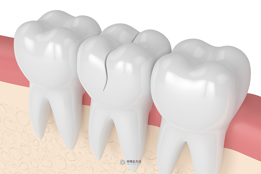 치아크랙｜치아에 금이 갔을 때 나타나는 증상은? 관련 이미지 3