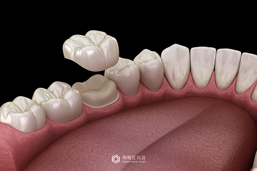 치과 크라운 나에게 맞는 종류가 있다? 관련 이미지 2