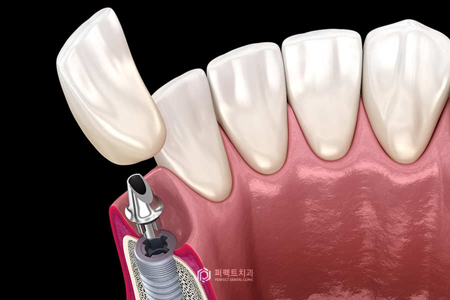 앞니 임플란트, 치아가 길어지는 이유는? 관련 이미지 1