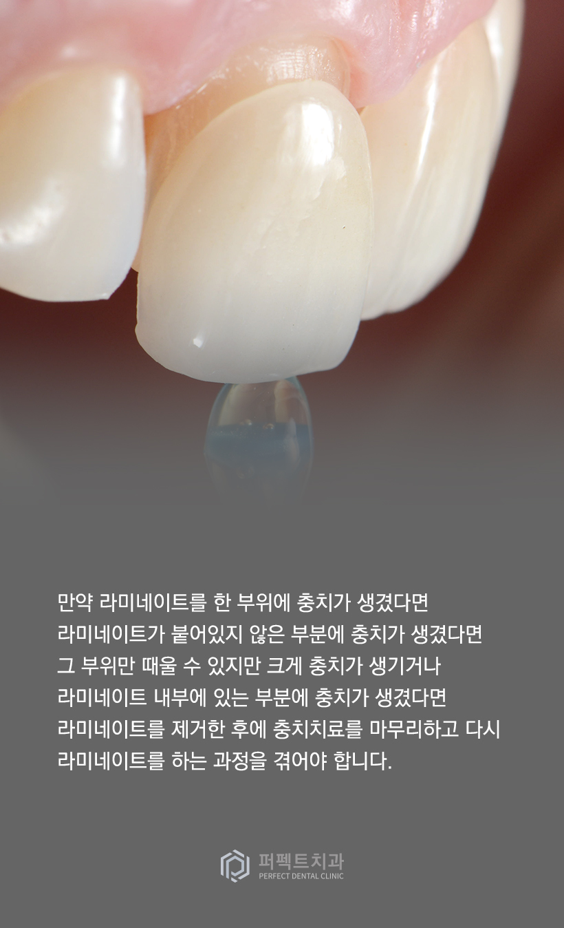 라미네이트에 충치가 생겼다면? 관련 이미지 4