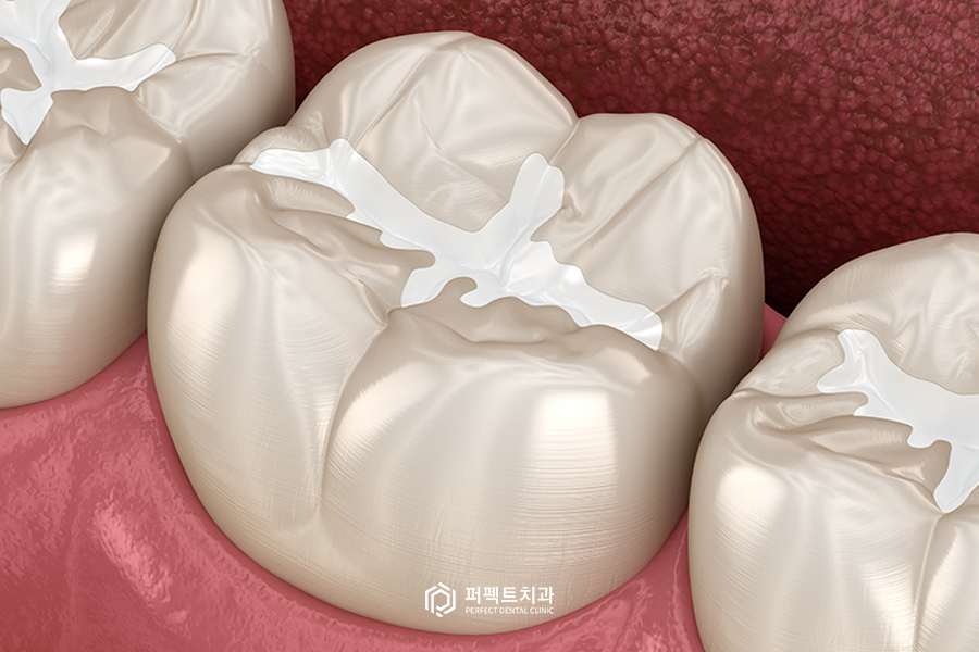 중기충치 관련 이미지 4