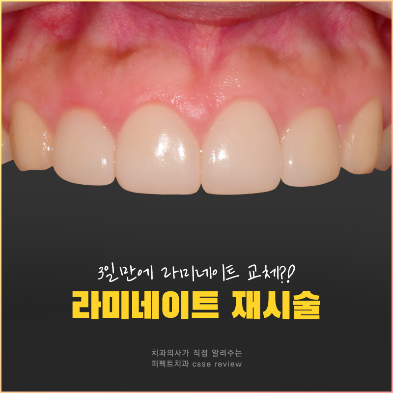 3일만에 라미네이트 교체를 결정한 이유는?😲 관련 이미지 1