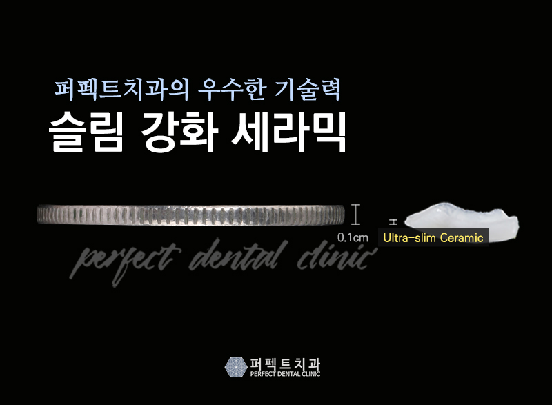 치과, 앞니 라미네이트 가격 관련 이미지 6