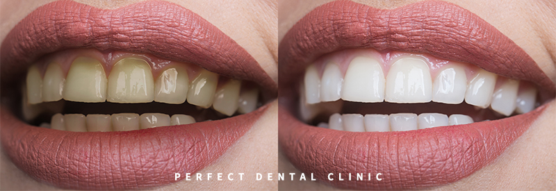 전문가 치아미백 가격얼마? 관련 이미지 1