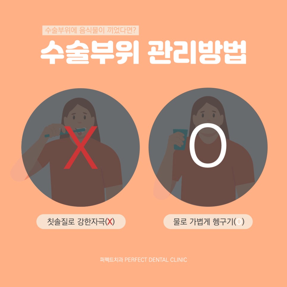 임플란트 후 바로 밥 먹을 수 있나요?(Feat.임플란트 후 주의사항) 관련 이미지 2