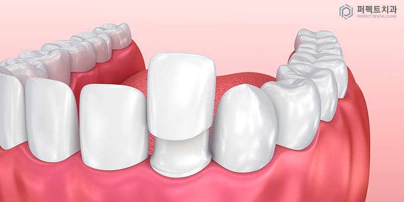 앞니 올세라믹 크라운 교체 관련 이미지 2