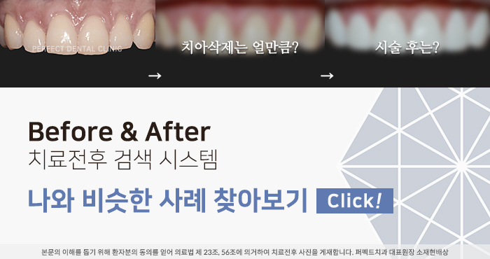 0.1mm 최소삭제, 앞니 라미네이트 후기 관련 이미지 5