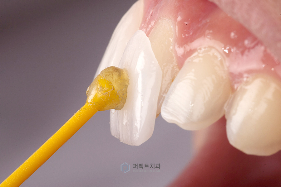 임시치아부터 라미네이트까지✨ 주의사항 알아보기 관련 이미지 3