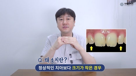 주변 치아보다 작은 관련 이미지 1