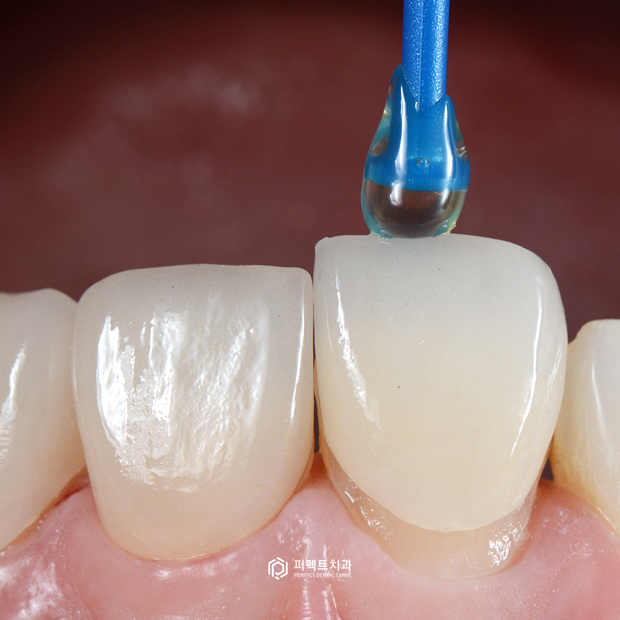 치아교정vs라미네이트, 대상은 어떻게 될까요? 관련 이미지 3