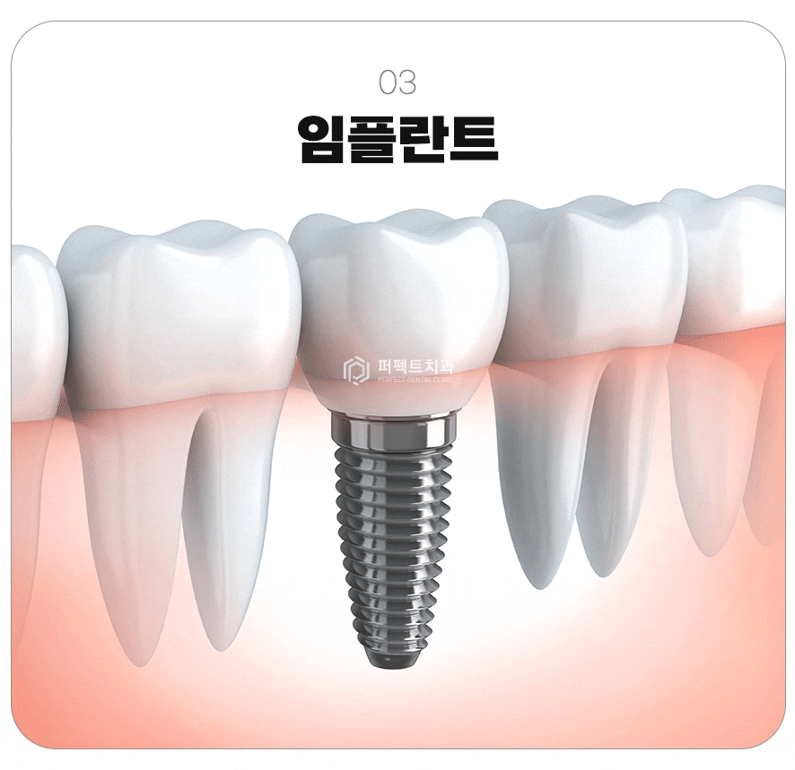 컴퓨터 분석을 통한 임플란트 관련 이미지 4
