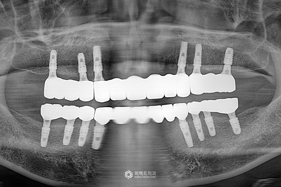 살릴 수 있는 치아가 없다면?❌｜전체임플란트 수복 관련 이미지 5