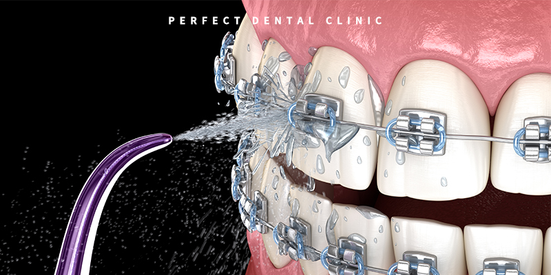치아교정 중 양치질 중요해요! 관련 이미지 3
