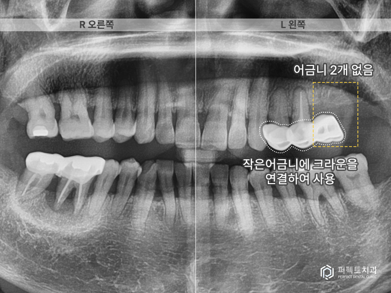 장거리+다수의 임플란트 케이스 관련 이미지 3