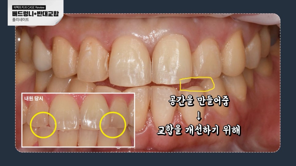 앞니 폴리네이트+치아미백 치료 관련 이미지 6