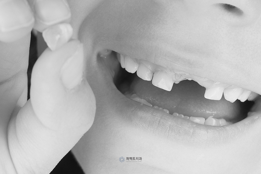 소아 치과치료②｜과잉치 발치는 어떻게? 관련 이미지 1