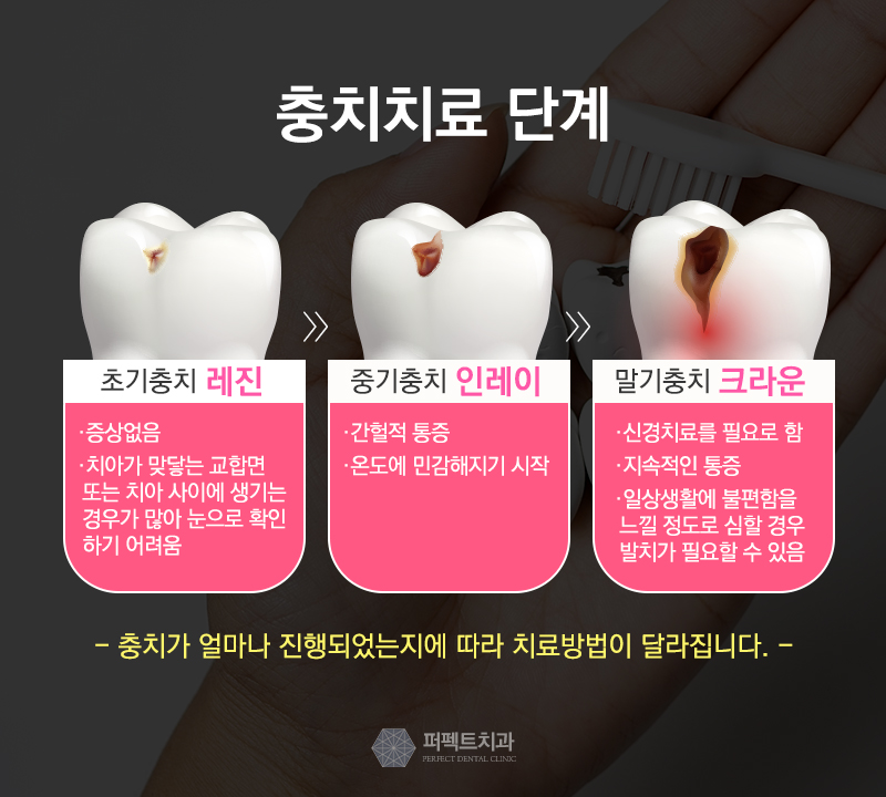 충치치료가격 관련 이미지 3