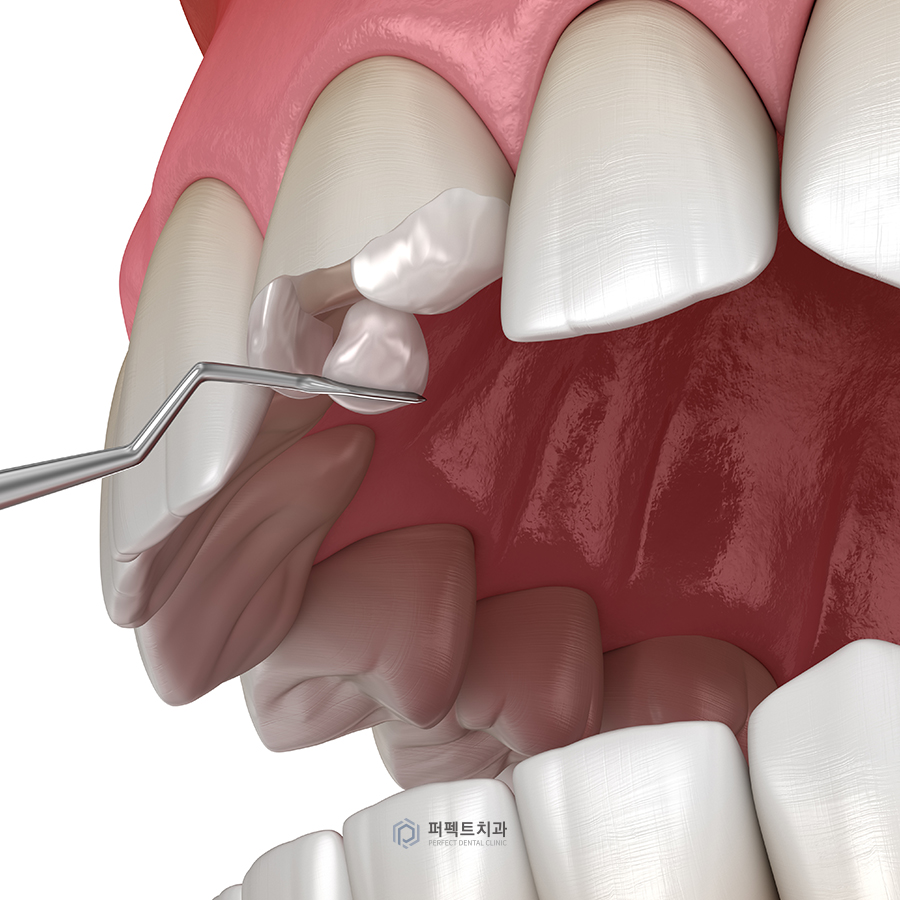 '블랙트라이앵글' 해결 방법은? 관련 이미지 2