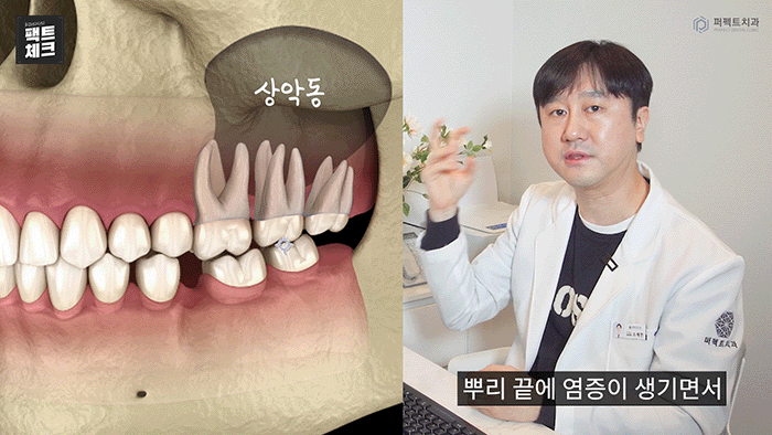 치통의 원인이 될 수 있는 상악동염이란? 관련 이미지 4