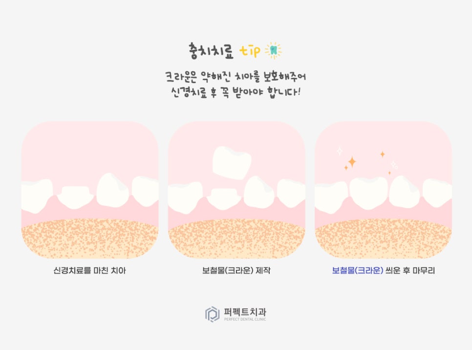 미룰수록 어려운 충치치료, 초기에 치료해요! 관련 이미지 8