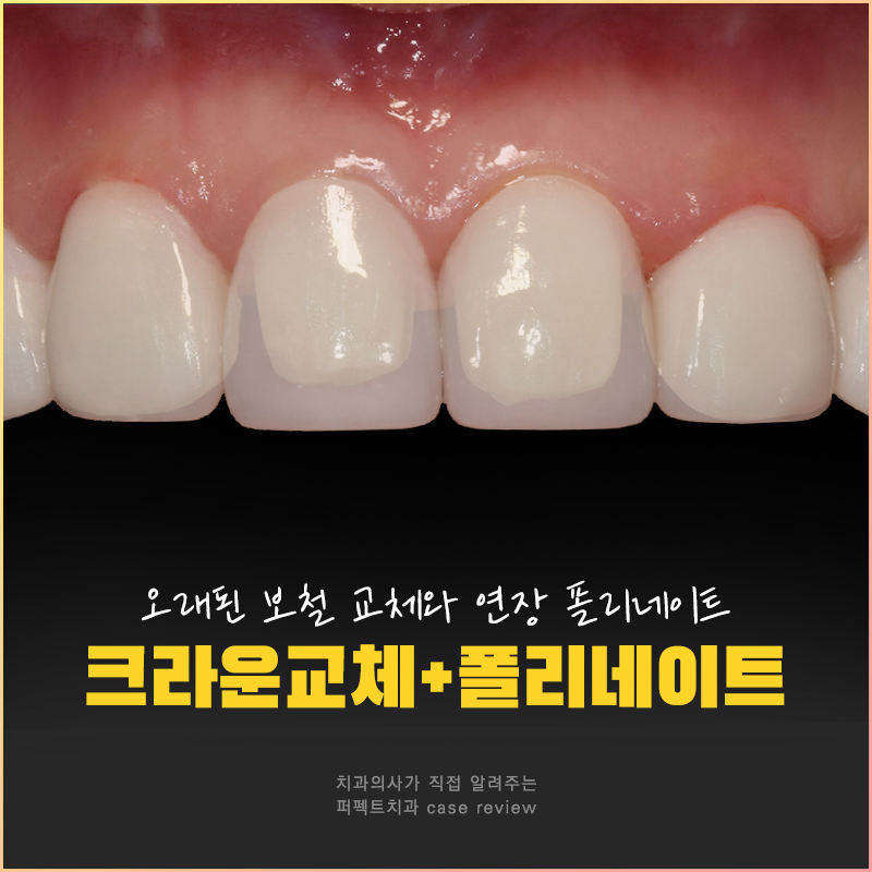 오래된 보철물 교체 및 폴리네이트까지! 관련 이미지 1