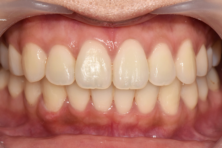 클리피씨를 이용한 부분교정, 얼마나 걸릴까? 관련 이미지 8