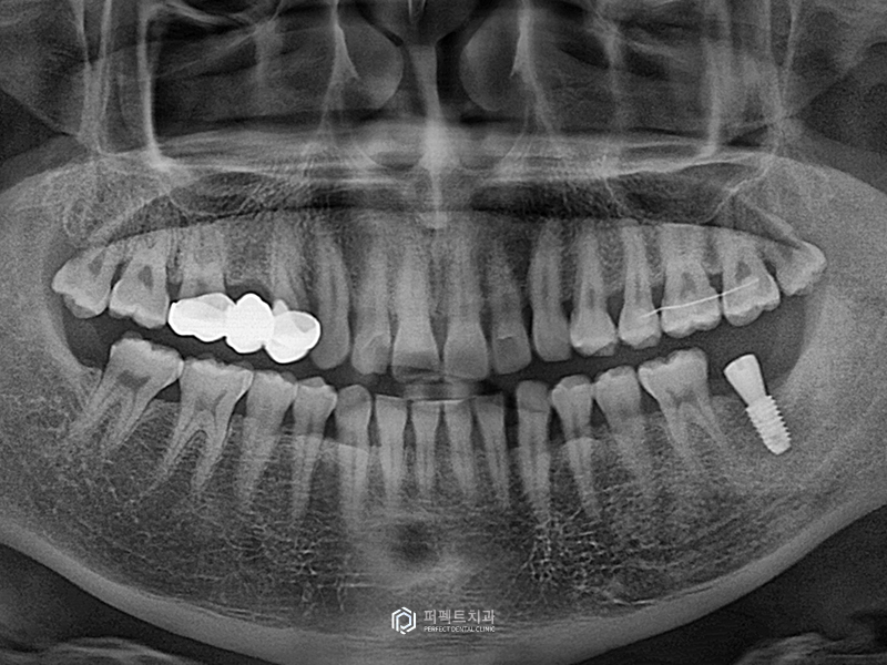 무절개 임플란트, 3분 안에 가능할까? 관련 이미지 5