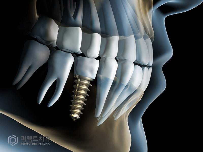 20대도 임플란트가 필요한가요? 관련 이미지 4