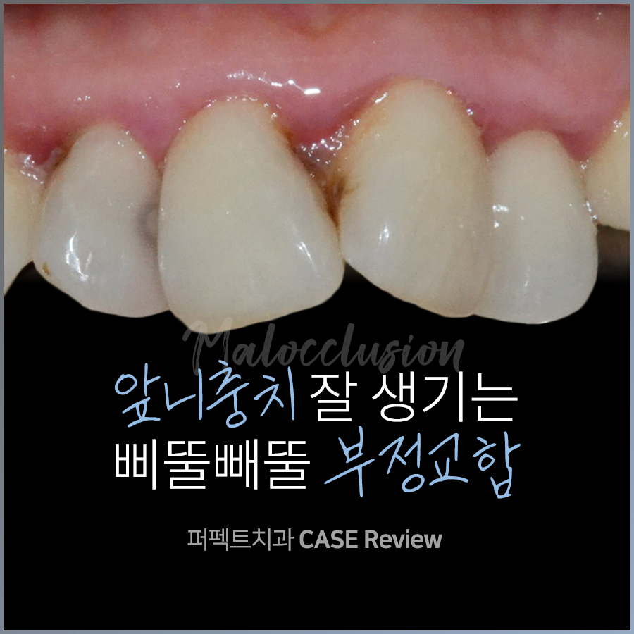 [부정교합+충치] 복합적인 문제를 가진 치아, 치료결과는? 관련 이미지 1