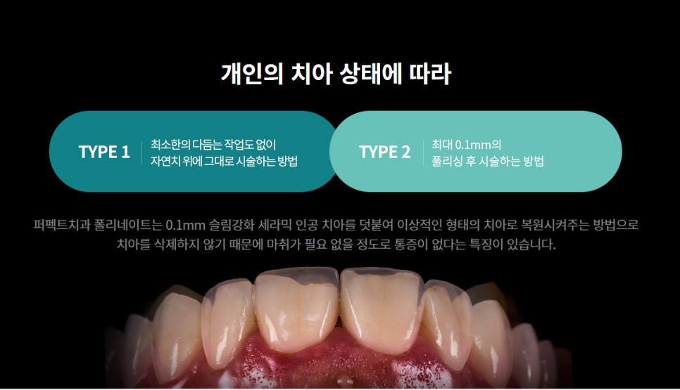 앞니 라미네이트 가격 공개! 관련 이미지 1