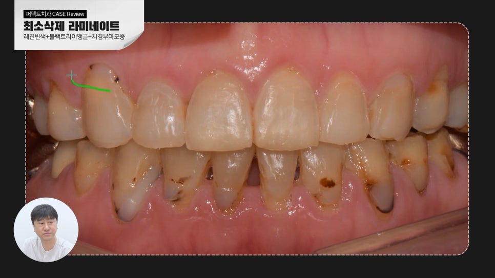 변색된 레진👉라미네이트 교체 관련 이미지 2