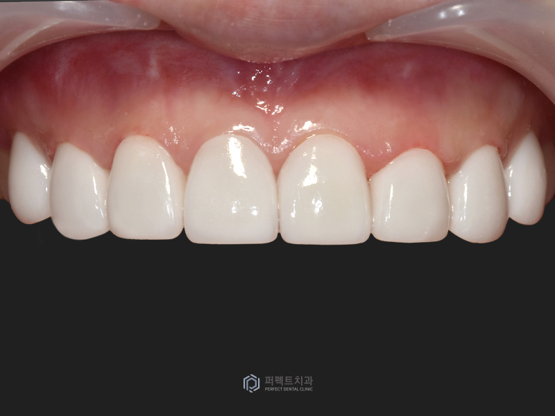 오래된 보철물 교체 및 폴리네이트까지! 관련 이미지 5