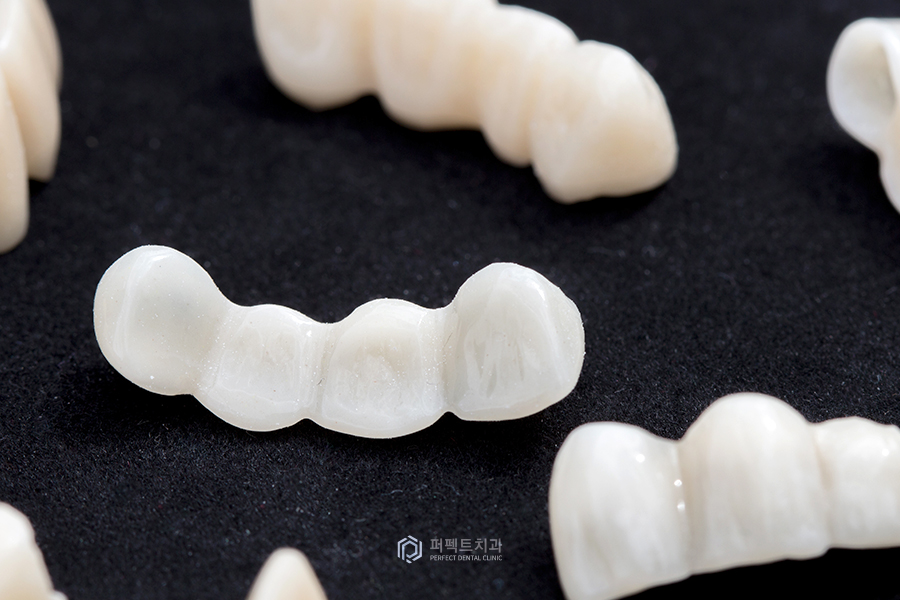 라미네이트 시 임시치아를 해야 하는 이유와 주의사항은? 관련 이미지 1