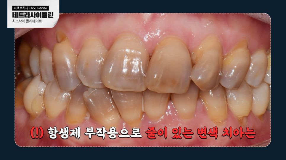 줄무늬 치아 테트라사이클린, 라미네이트vs치아미백 어떤 치료? 관련 이미지 3