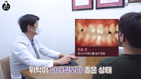 MARPE 악궁확장장치로 위턱 넓히기?! 관련 이미지 3