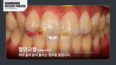 남자라미네이트 치료 결과는? 관련 이미지 2