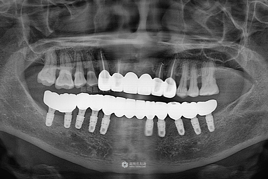 윗니 전체 신경치료 했다고?😱 교합평면이 뭐길래 관련 이미지 6