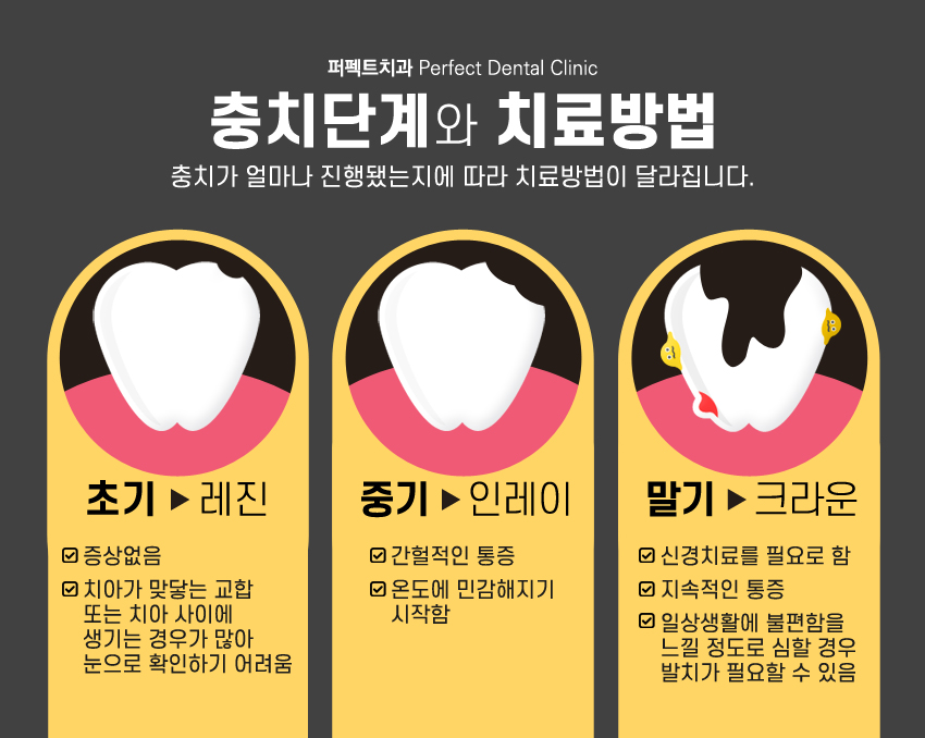 치과치료 후 충치가 또 생겼다면? 관련 이미지 3
