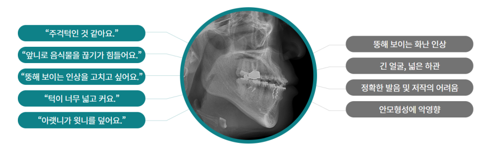 턱을 넓히는 악궁확장장치(MARPE), 왜 사용하는걸까? 관련 이미지 2
