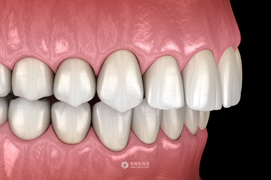 치료해도 자꾸 벌어지는 치아..😨 원인은? 관련 이미지 7